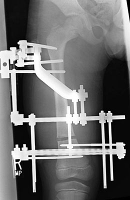 Femur Lengthening using External Fixator