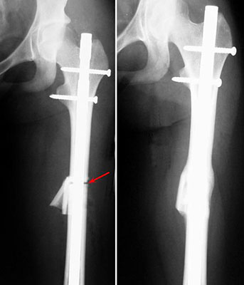 Shortening of Femur