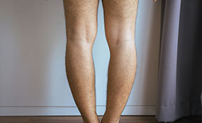 Corrección de piernas arqueadas Miami Beach FL